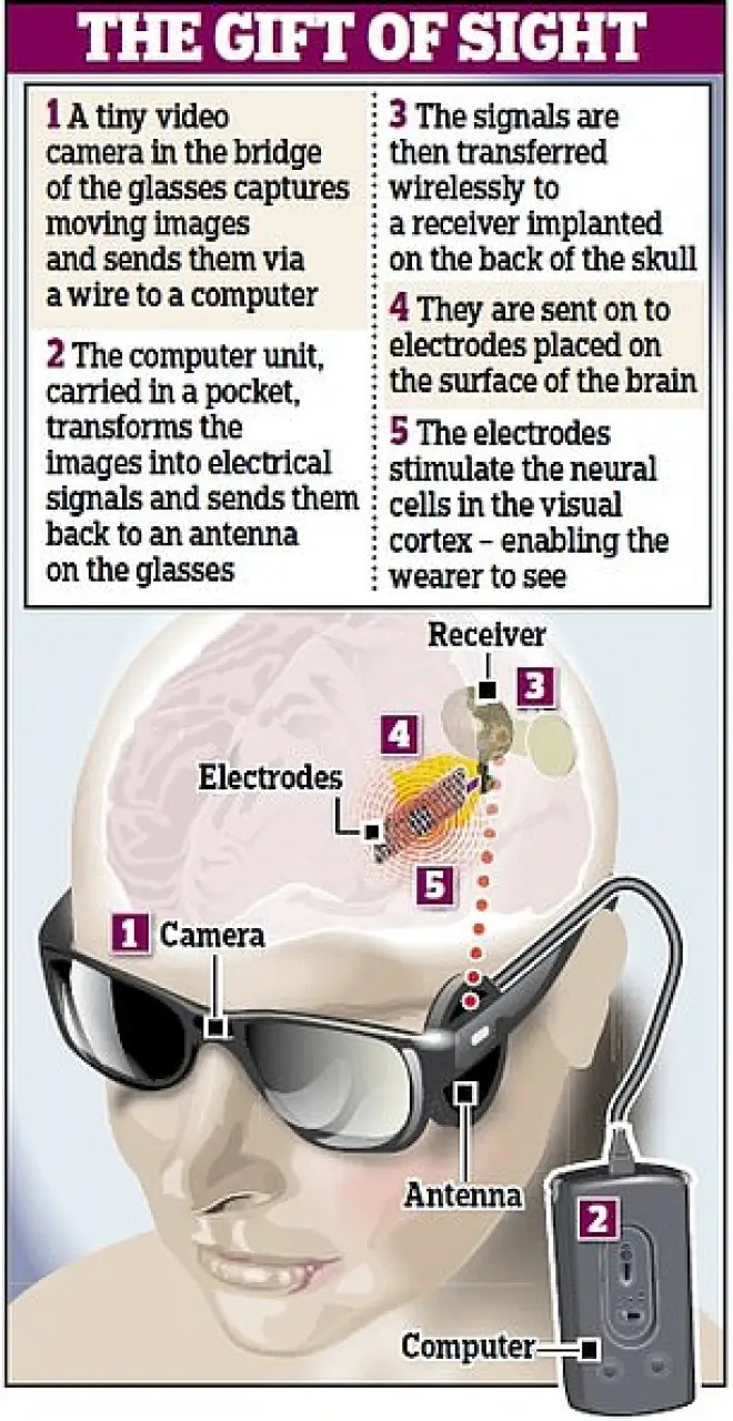 Dispositivo cerebrale ipovedenti: Orion.