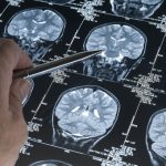 Medulloblastoma: arriva una nuova terapia %medulloblastoma: arriva una nuova terapiacount(title)% Medulloblastoma: arriva una nuova terapia