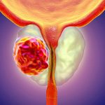 Lu-psma-617: il nuovo trattamento che combatte il cancro prostatico %lu-psma-617: il nuovo trattamento che combatte il cancro prostaticocount(title)% Lu-psma-617: il nuovo trattamento che combatte il cancro prostatico