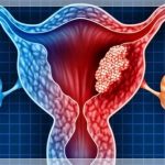 In studio un promettente radiofarmaco contro il cancro ovarico