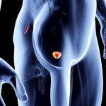Darolutamide, potente alleato contro il carcinoma prostatico %darolutamide, potente alleato contro il carcinoma prostaticocount(title)% Darolutamide, potente alleato contro il carcinoma prostatico