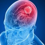 Meningioma: potrebbe nascere dalla dura madre? Cosa mostra il nuovo atlante