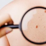 Melanoma: la vitamina b3 ne inibisce la crescita