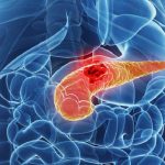 Cancro al pancreas: un aiuto dall'ingegneria biomedica