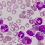 Leucemia linfoblastica acuta: 2 geni prevedono la gravità %leucemia linfoblastica acuta: 2 geni prevedono la gravitàcount(title)% Leucemia linfoblastica acuta: 2 geni prevedono la gravità