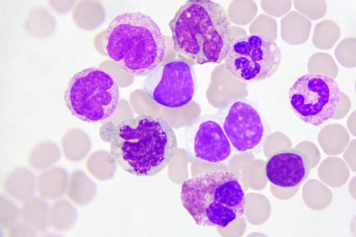 Leucemia linfoblastica acuta