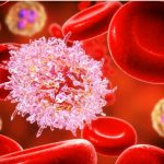 Leucemia linfoblastica acuta ph+: ecco la nuova terapia %leucemia linfoblastica acuta ph+: ecco la nuova terapiacount(title)% Leucemia linfoblastica acuta ph+: ecco la nuova terapia