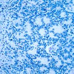 Simpaticoblasti: ecco le cellule embrionali che causano i neuroblastomi %simpaticoblasti: ecco le cellule embrionali che causano i neuroblastomicount(title)% Simpaticoblasti: ecco le cellule embrionali che causano i neuroblastomi