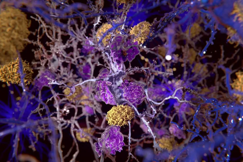 Alzheimer, fattore chiave, litio, RX intranasale, perdita dei neuroni