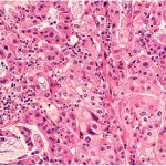 Curcusone d combatte proteina brat1 "undruggable" del cancro