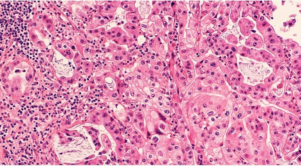 Curcusone d combatte proteina brat1 "undruggable" del cancro