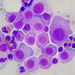 Farmaco inverte danno al gene dyrk1a associato all'autismo