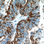 Proteina serpina5: gene che la codifica aggrava l'alzheimer