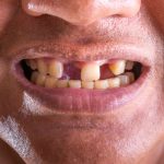 Rigenerazione dei denti persi grazie a studi sul gene usag-1