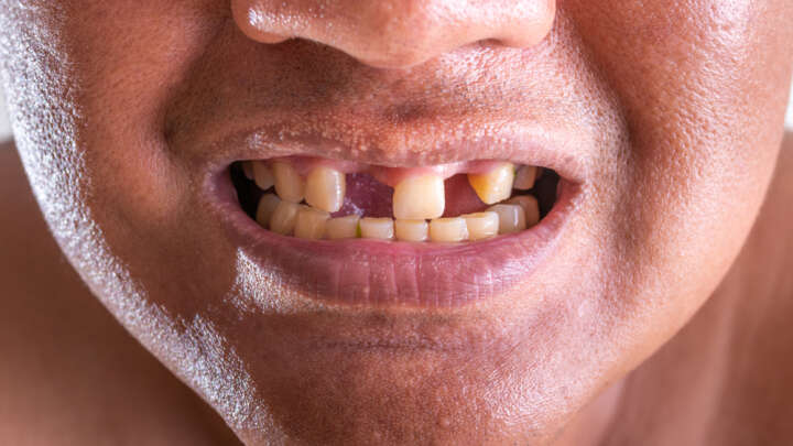 Rigenerazione dei denti persi