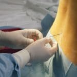 L'epidurale è correlata alla diagnosi di autismo?