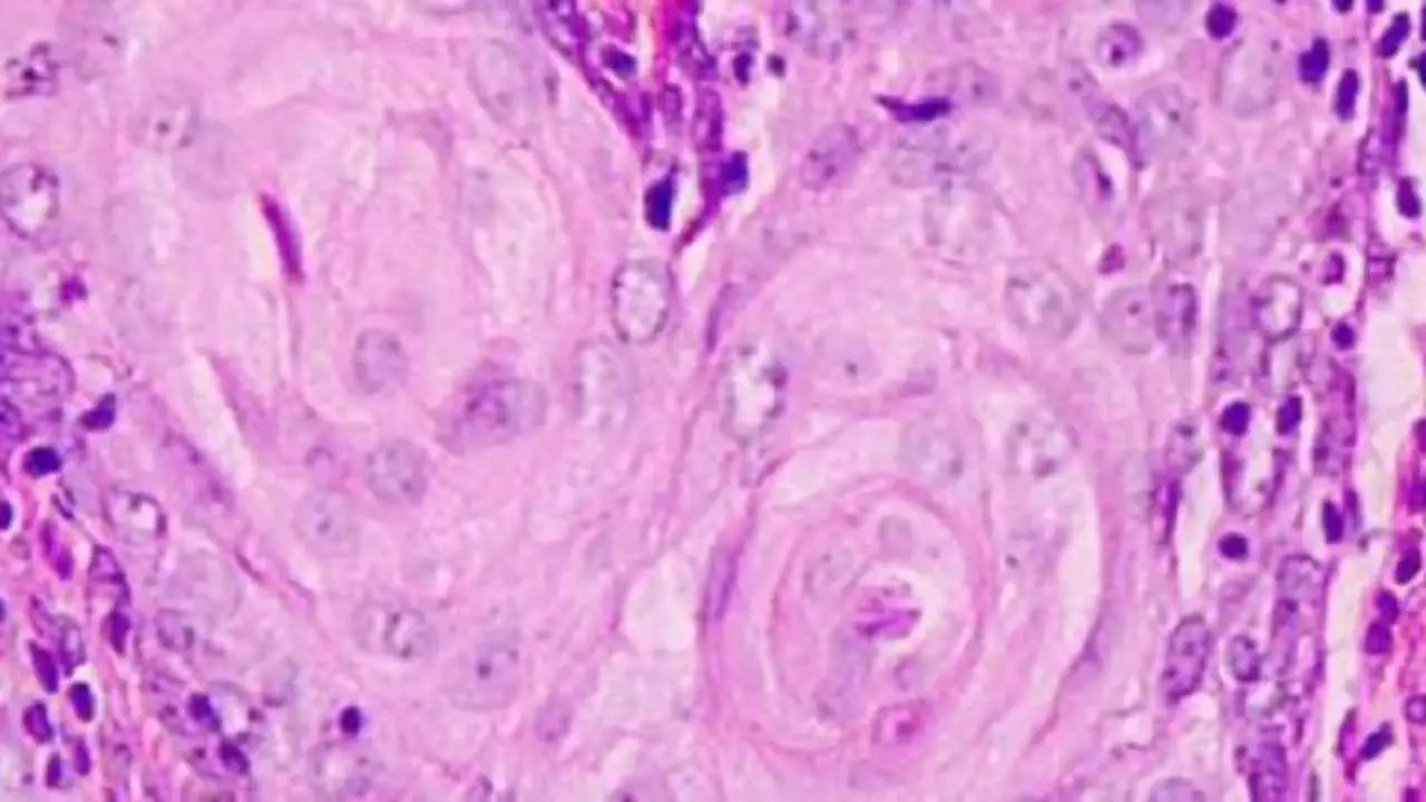 Glioblastoma multiforme