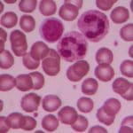 Maggiore rischio di leucemia nei bambini con trisomia 21?