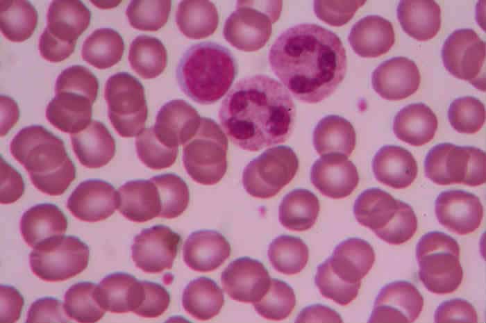 Maggiore rischio di leucemia nei bambini con trisomia 21?