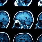 Brain glue: l'idrogel che aiuta nella riparazione neurale funzionale %brain glue: l'idrogel che aiuta nella riparazione neurale funzionalecount(title)% Brain glue: l'idrogel che aiuta nella riparazione neurale funzionale