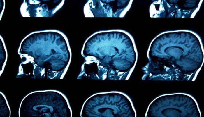 Brain glue: l'idrogel che aiuta nella riparazione neurale funzionale