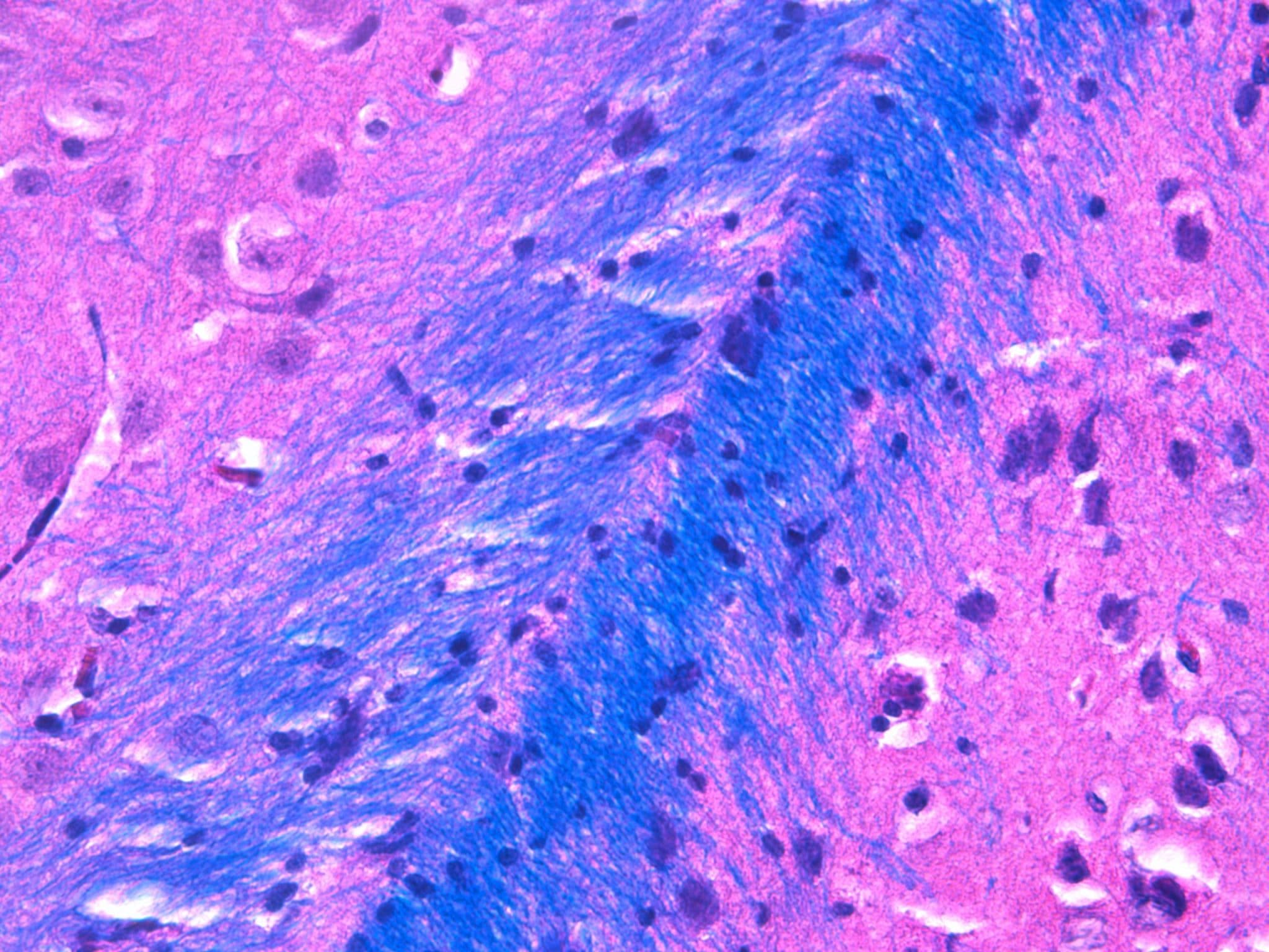 Proteina slc7a11: la chiave che blocca la sclerosi multipla?