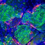 Gad65: la proteina vaccino promettente contro il diabete 1 %gad65: la proteina vaccino promettente contro il diabete 1count(title)% Gad65: la proteina vaccino promettente contro il diabete 1