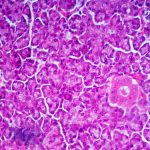 Individuate varianti genetiche nel diabete di tipo 1 %individuate varianti genetiche nel diabete di tipo 1count(title)% Individuate varianti genetiche nel diabete di tipo 1