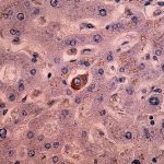 Gene her2: una sua mutazione può aggravare il cancro al seno