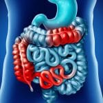 Cancro del colon retto: trovato legame biologico con la carne rossa