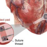 Arriva il primo pacemaker transitorio che si autodissolve