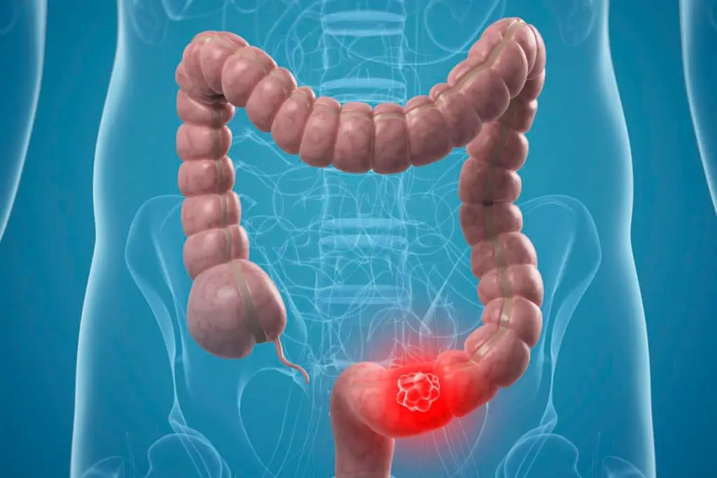 Cancro del colon retto