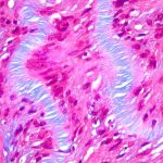 Tumori benigni: analisi del sangue rivelano quando diventano maligni %tumori benigni: analisi del sangue rivelano quando diventano malignicount(title)% Tumori benigni: analisi del sangue rivelano quando diventano maligni