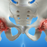 Osteoporosi dalla radiografia del torace: cosa rivela uno studio sull'ai