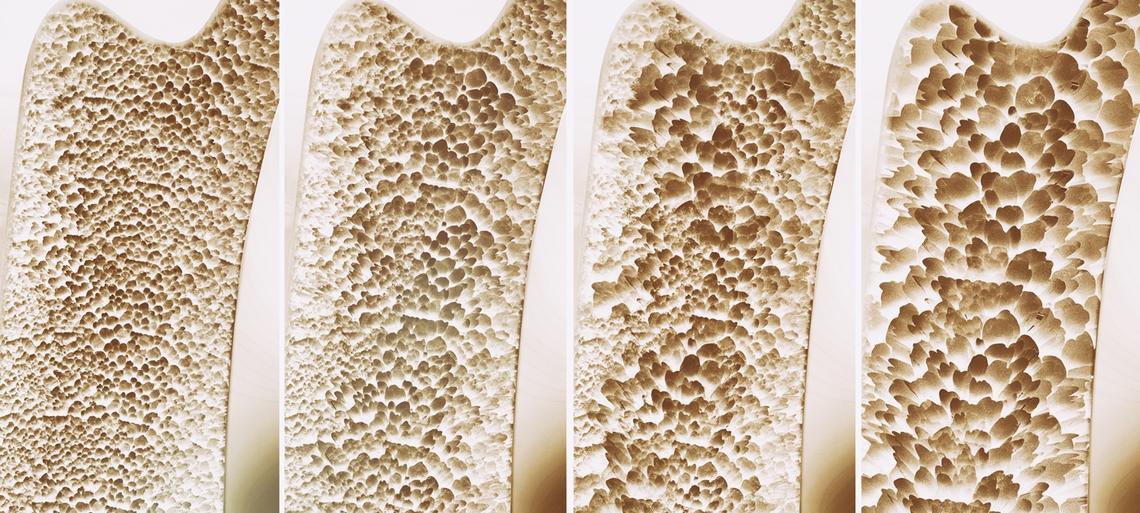 Campi elettromagnetici contro l’osteoporosi? Cosa mostra lo studio %campi elettromagnetici contro l’osteoporosi? Cosa mostra lo studiocount(title)% Struttura dell’osso interessata dall’osteoporosi