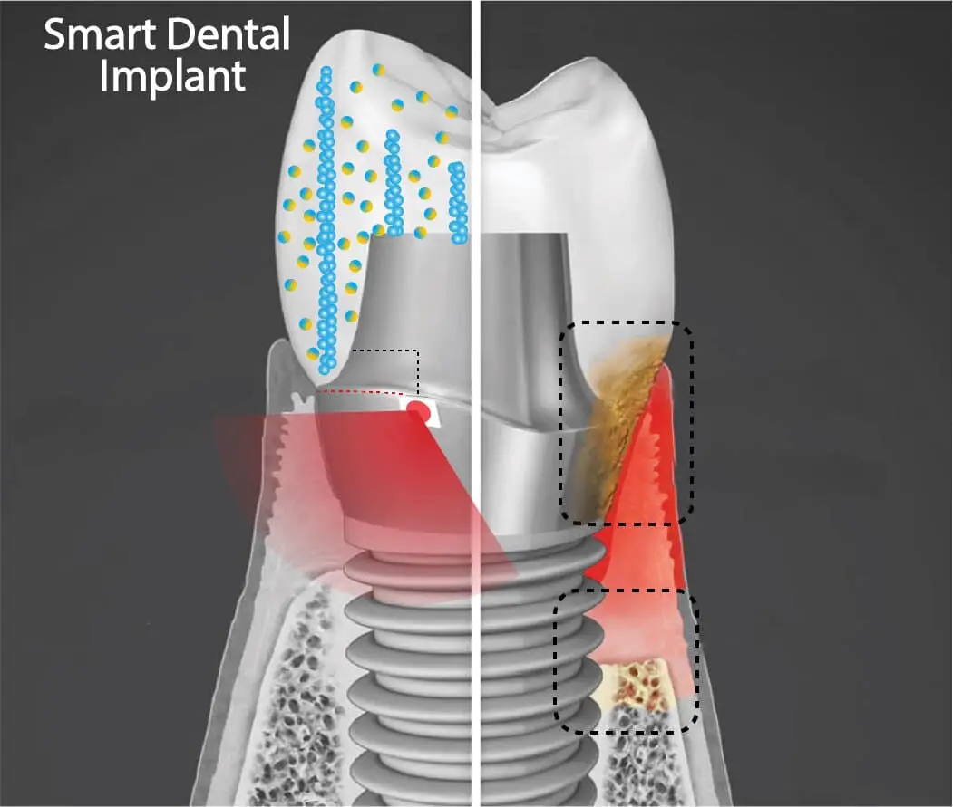 Impianto dentale smart