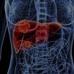 Cancro al fegato: ai dà speranza di sopravvivenza a chi ne ha meno del 13%