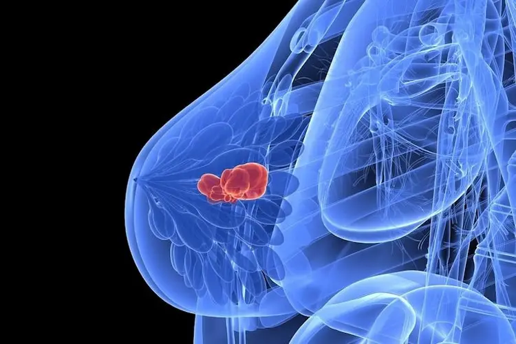 Carcinoma mammario triplo negativo