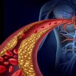 Arteriosclerosi: perché le donne in premenopausa sono a rischio?