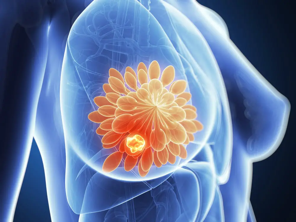 Trastuzumab deruxtecan, tamoxifen, breast cancer