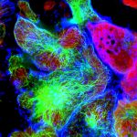 Carcinoma mammario triplo negativo: arrivano terapie personalizzate sui propri dati genici