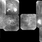 Retinopatia diabetica: la luce blu ne intercetta le aree colpite