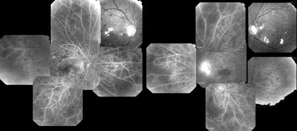 Retinopatia diabetica: la luce blu ne intercetta le aree colpite