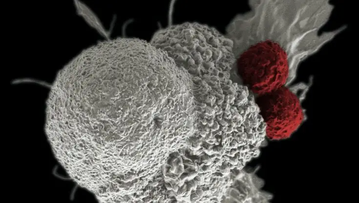 Cancro al pancreas: ecco perché le cellule cancerose sono così aggressive 