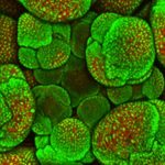 La chemioterapia potenzia la diffusione del cancro?