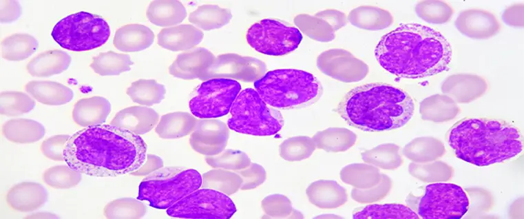 Leucemia mieloide acuta 