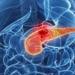 Ultrasuoni: nuova arma contro il tumore al pancreas %ultrasuoni: nuova arma contro il tumore al pancreascount(title)% Ultrasuoni: nuova arma contro il tumore al pancreas
