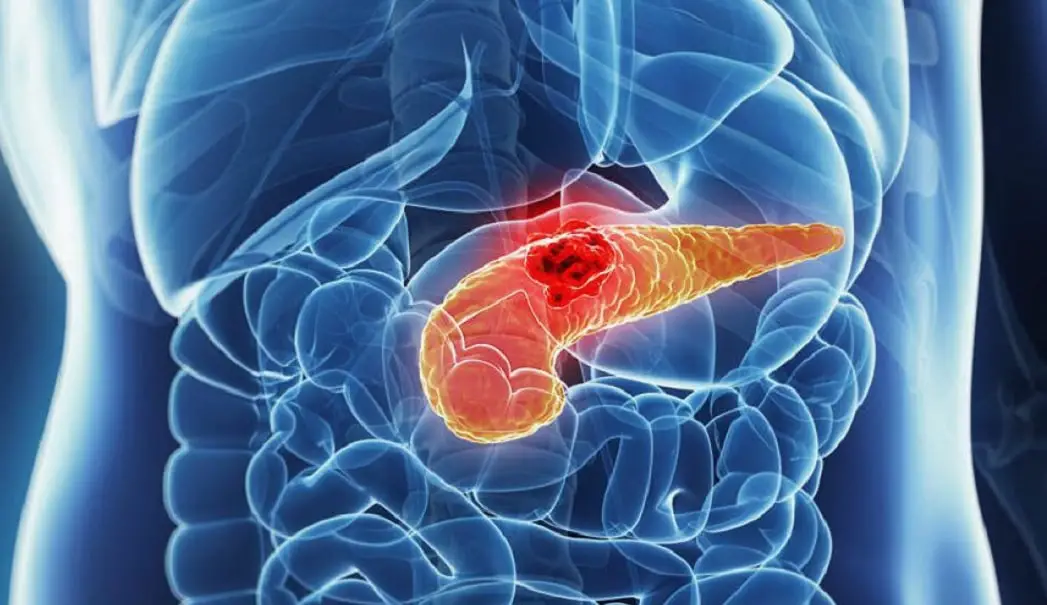 Molecola mmri62, tumore al pancreas stadio 1, cancro al pancreas, immunoterapia