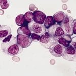 Leucemia promielocitica: combo di farmaci evita chemio ai bambini %leucemia promielocitica: combo di farmaci evita chemio ai bambinicount(title)% Leucemia promielocitica: combo di farmaci evita chemio ai bambini