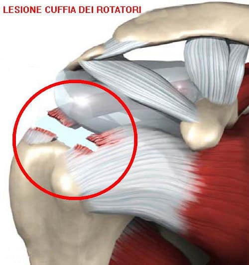 Rotator cuff